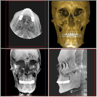 i-CAT dental imaging is the perfect tool for diagnosing a variety of dental cases